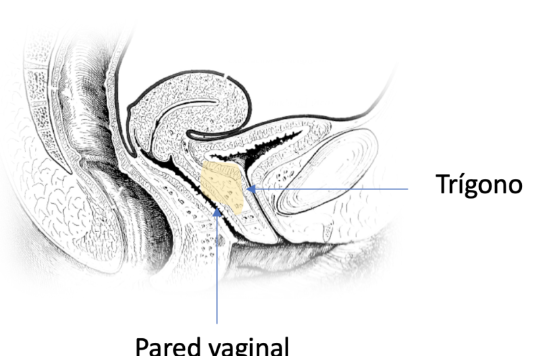 rejuvenecimiento vaginal